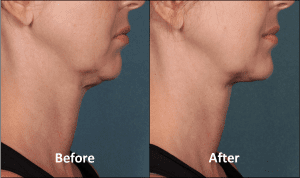 KYBELLA Patient Before and After (Side View) (1)