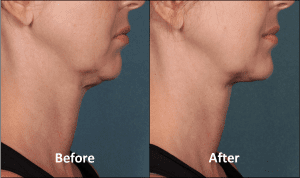 KYBELLA Patient Before and After Side View 1