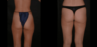 Liposuction Outer Thighs Before and After 