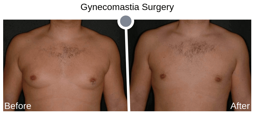 Gynecomastia Before and After Photos