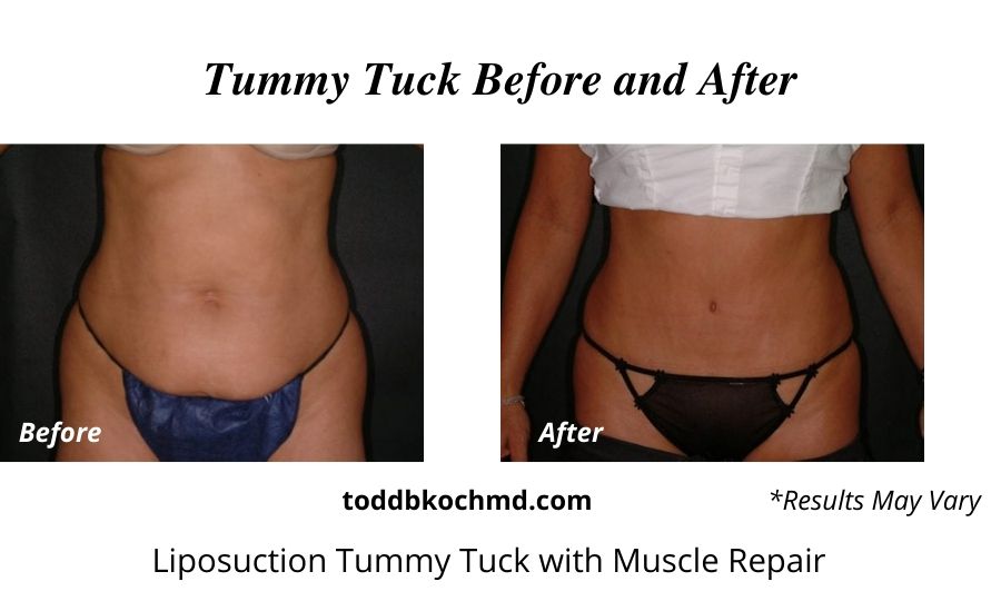 Before and after photos of a tummy tuck patient who underwent surgery with Dr. Koch in Williamsville, NY.