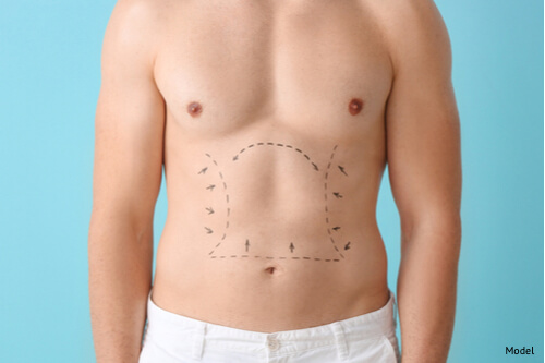 Man standing shirtless with surgical lines drawn on chest in preparation for plastic surgery.
