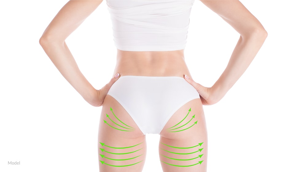 Backside of a woman with surgical lines drawn on thighs and buttocks to show the potential benefits of buttock augmentation.