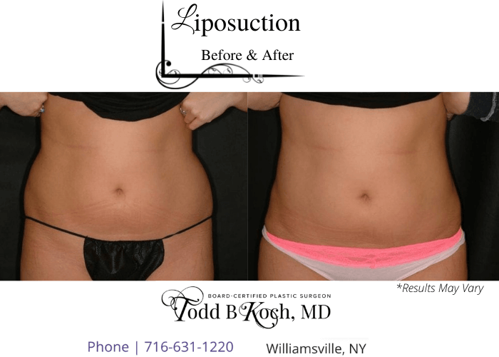 Before and after image showing a liposuction treatment performed in Williamsville, NY.