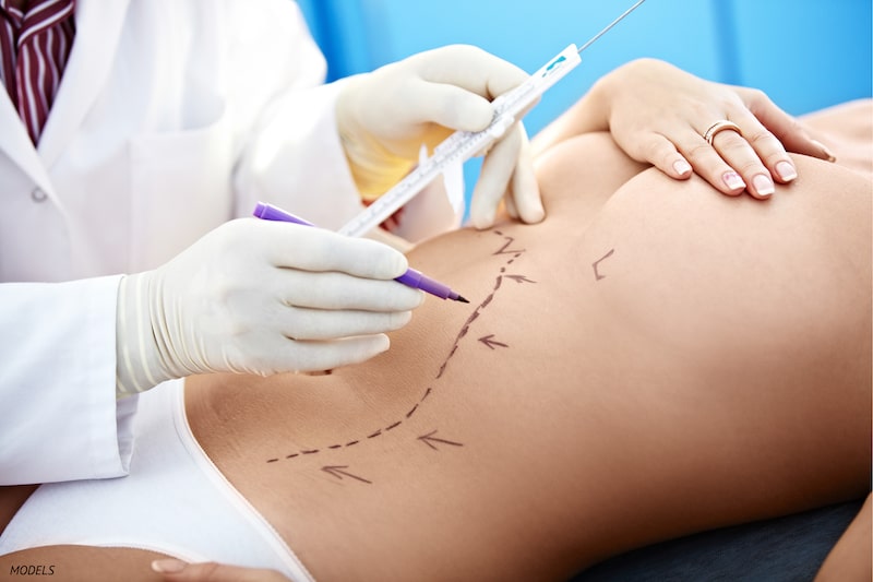 Surgeon drawing body contouring lines on woman's stomach.