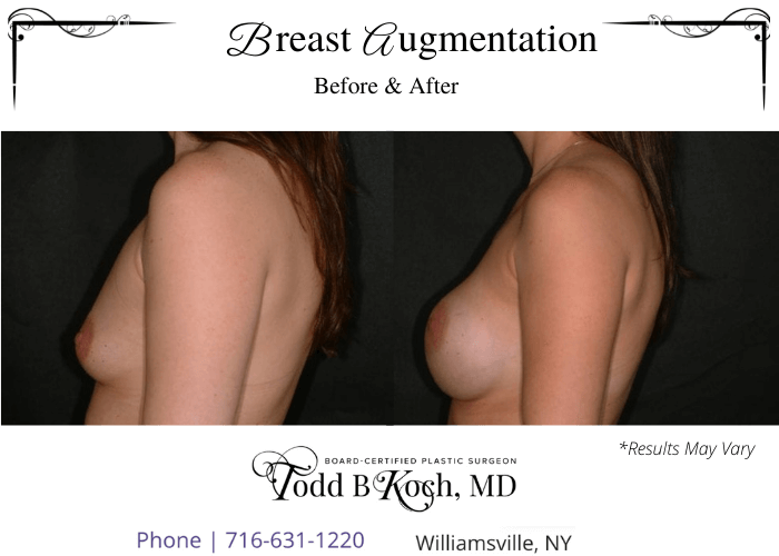 Before and after results of breast augmentation performed in Williamsvile, NY.