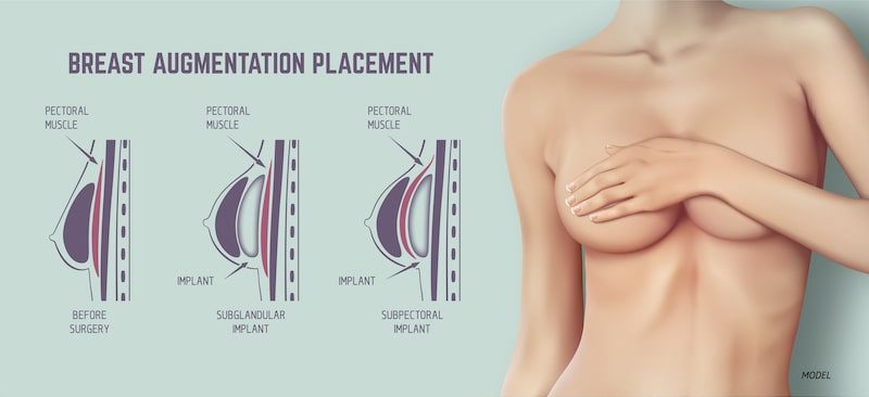 breast implant diagram