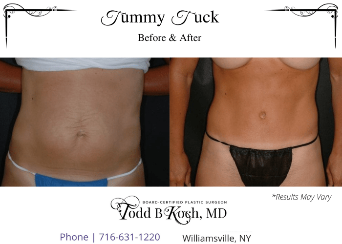 Before and after image showing the results of a tummy tuck performed in Williamsville, NY.