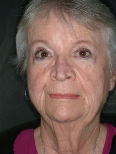 Face/Neck Lift 01 Before 1