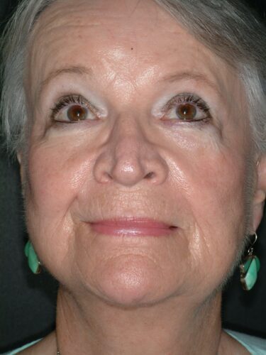 Face/Neck Lift 01 After 1