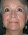 Face/Neck Lift 01 After 1 - Thumbnail