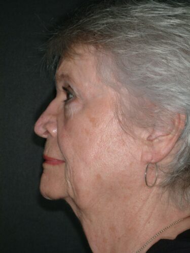 Face/Neck Lift 01 Before 1