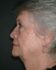 Face/Neck Lift 01 Before 1 - Thumbnail