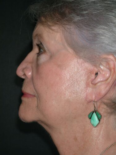 Face/Neck Lift 01 After 1
