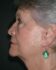 Face/Neck Lift 01 After 1 - Thumbnail