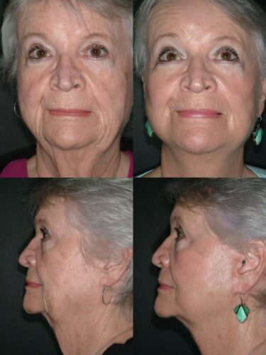 Face/Neck Lift 01 Before 1