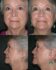 Face/Neck Lift 01 Before 1 - Thumbnail