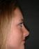 Rhinoplasty 01 After 1 - Thumbnail
